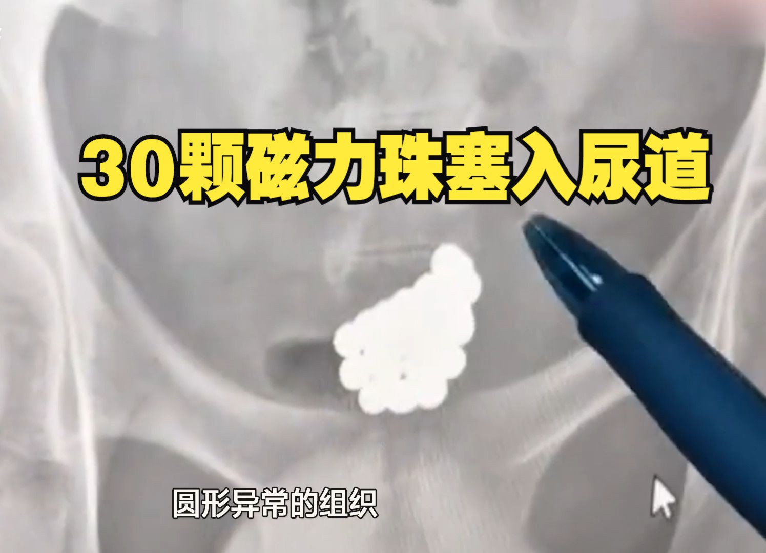 14岁男孩将30颗磁力珠塞入尿道 几乎塞满整个尿道