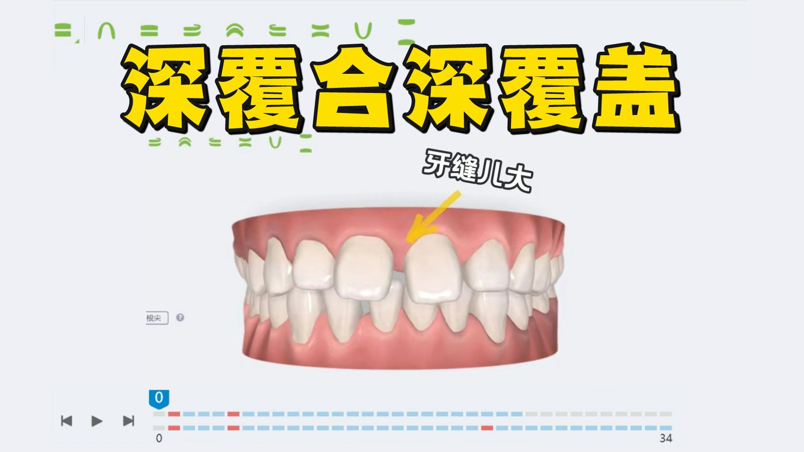 【正畸方案】深覆合深覆盖+牙周炎，如何安全矫正？