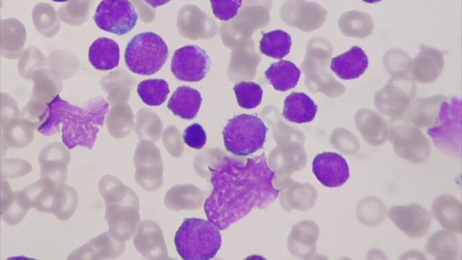 急性淋巴细胞白血病-外周血涂片