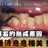 大量牙结石的形成，除了刷牙不认真，还有哪些原因？