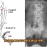 影像知识科普：输尿管三个生理性狭窄讲解，输尿管结石病例分享