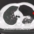 “气胸”在CT和胸片上分别什么表现？放射科医生讲解，简单易懂