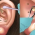 令人极度舒适的耳部清洁过程，去除囊肿 | 定格动画 | 解压动画