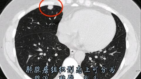 几个月长出了结节可能是肿瘤吗 59359005cedd16b5cb5626e165d188a20e24272a.jpg@480w_270h_1c