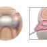 经鼻孔垂体瘤切除术，3D演示。。