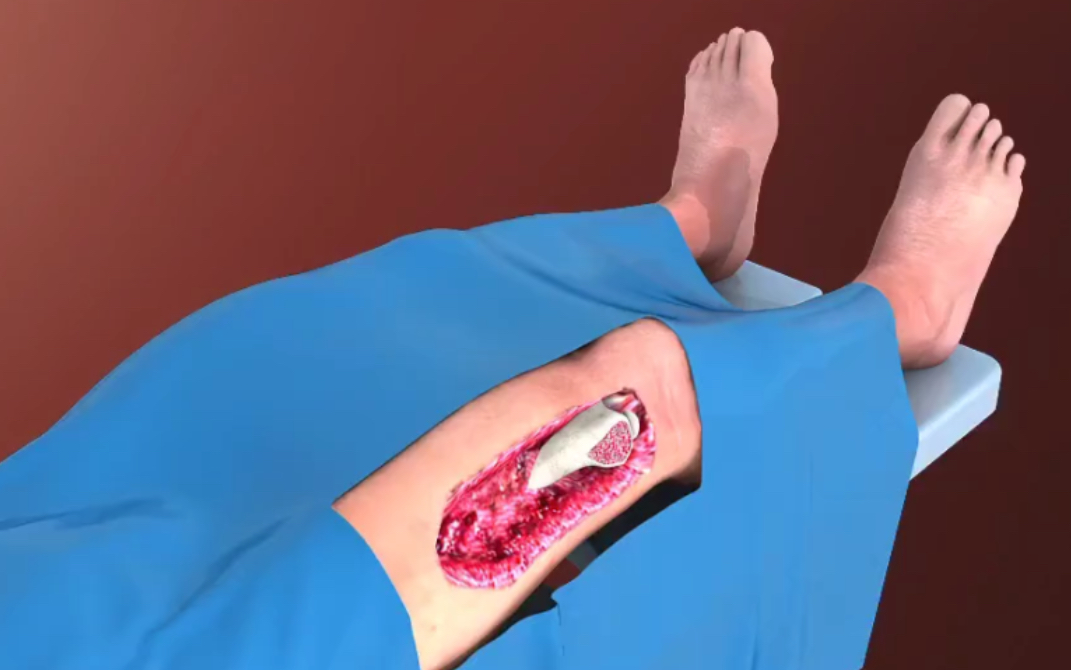 【3D演示】生命禁区手术，腿部严重损伤无法自愈，背部皮瓣移植手术。