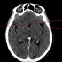 2.颅脑CT解剖图谱-脑动脉CT解剖