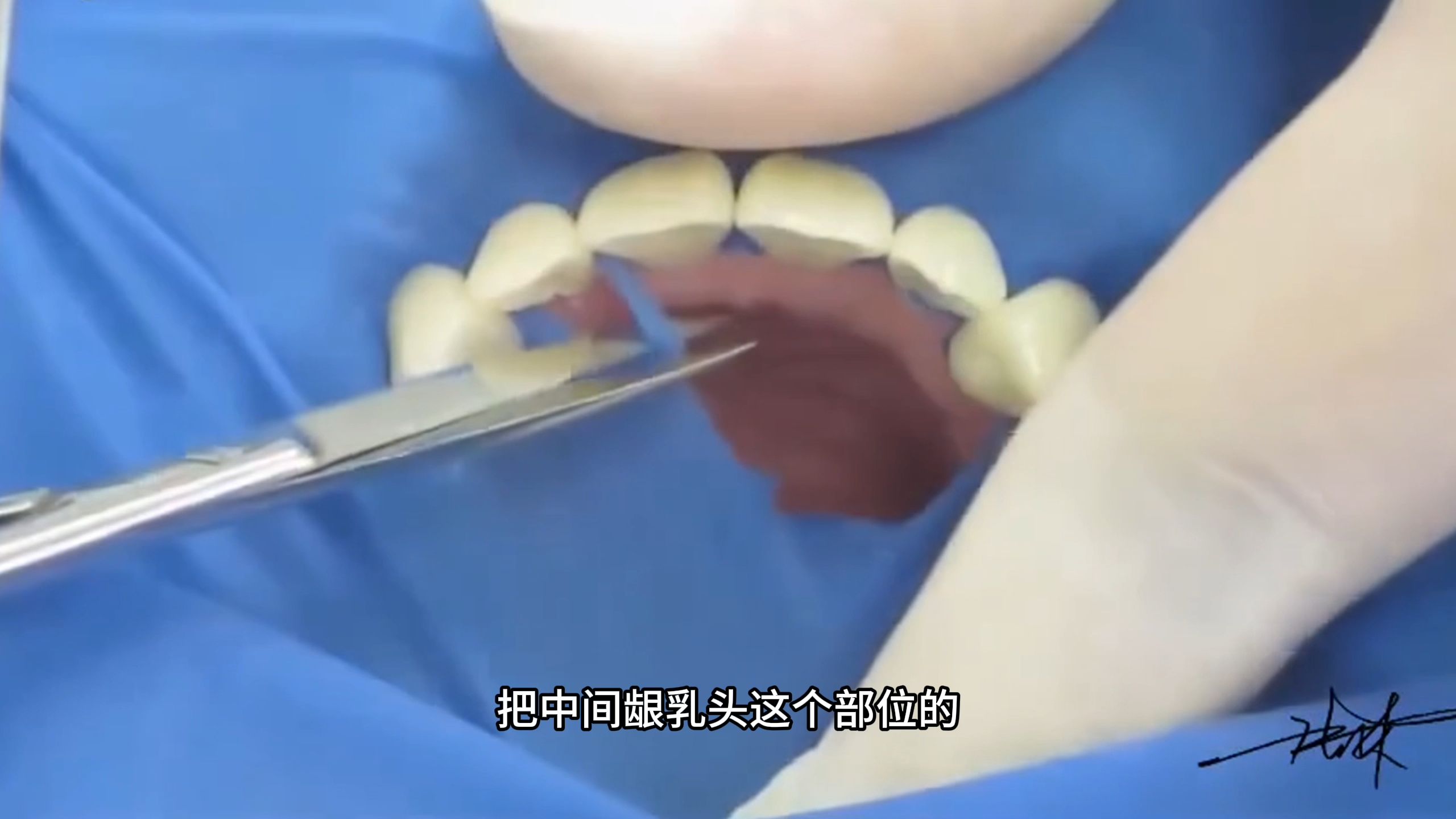 【张林】5天学会做嵌体5——硅橡胶印模+上橡皮障