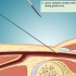 【临床医学】+经股动脉穿刺的心导管术+无声、无字幕