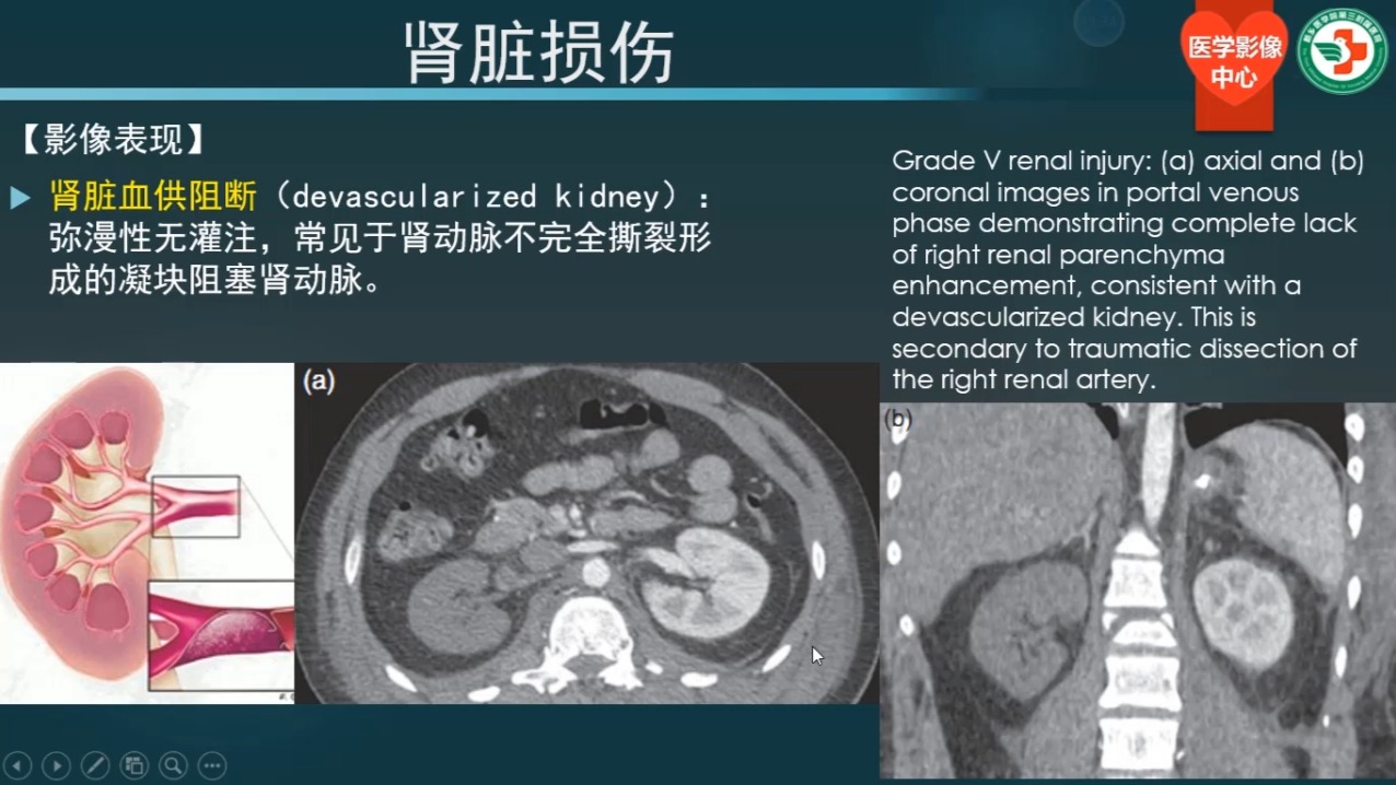 第十讲、创伤性急腹症03（共30讲）