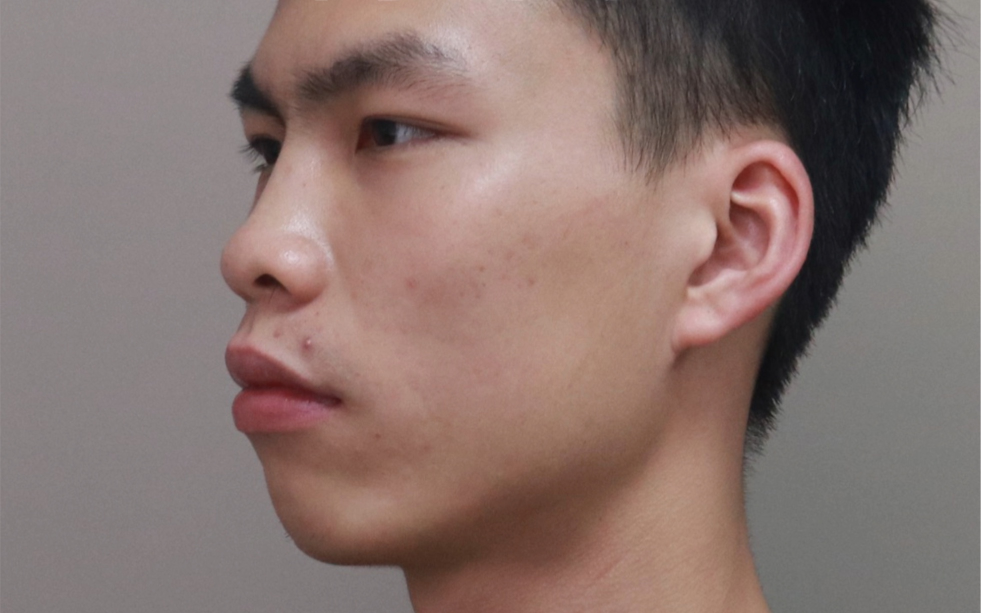 22岁男孩凸嘴、下巴后缩矫正，正颌后3个月的对比