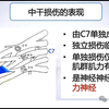 臂丛神经损伤