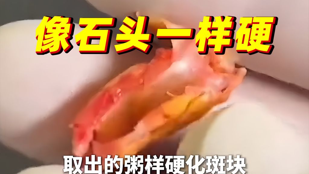 这是硬化后的血管和斑块，像石头一样硬，饮食高油高盐的要注意！