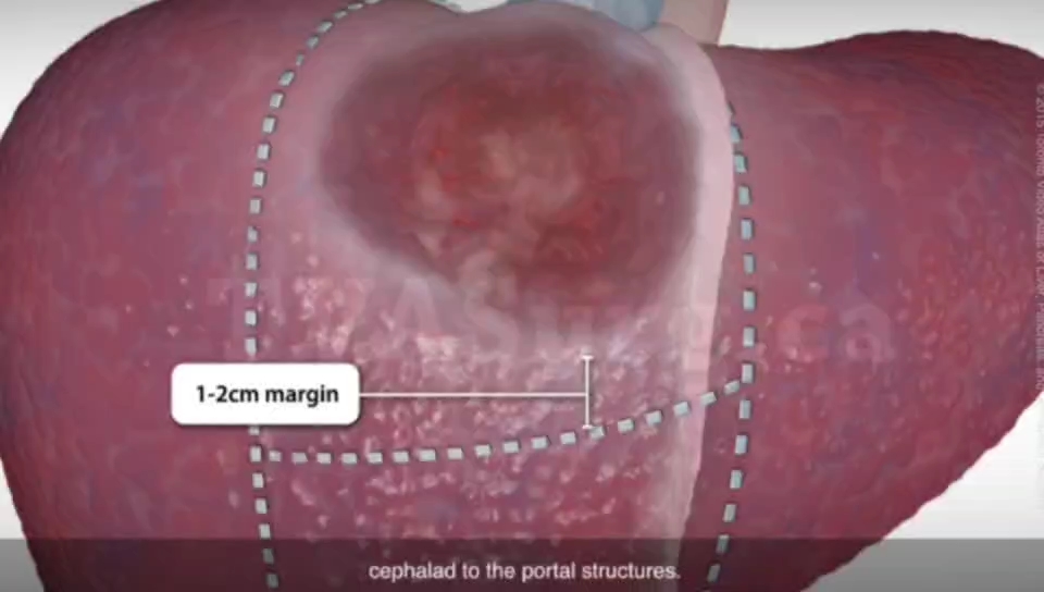肝脏肿瘤切除手术过程，3D演示。。