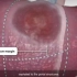 肝脏肿瘤切除手术过程，3D演示。。