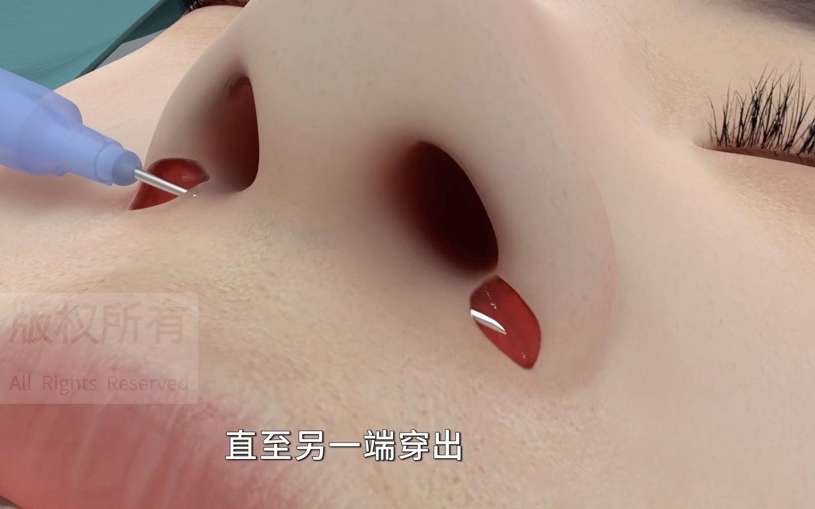 动画演示鼻翼宽大缩小手术。