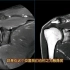 肩关节MRI病例：肩周炎影像分享，动态图像观察讲解！