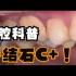 30岁男子的口腔健康状况，牙结石C+