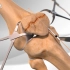 4大膝盖中箭合集，3D演示髌骨骨折、换半月板、髌骨粉碎性骨折、全膝关节置换手术的过程
