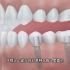 牙医告诉你，种植牙修复过程以及价格