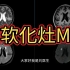 影像报告解读：脑软化灶MRI表现分享，动态图像观察，简单易懂！