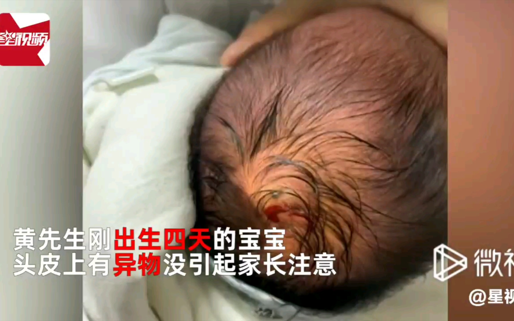 江西男子发现刚出生4天宝宝头皮上有东西 用手一拨吓坏了
