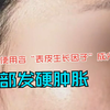 女子疑使用含“表皮生长因子”成分护肤脸部发硬肿胀