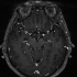 『端脑』颞叶解剖及影像表现.mp4