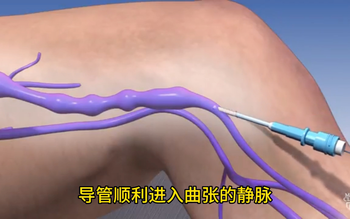 激光消融技术治疗下肢静脉曲张动画演示，比传统手术创伤小！