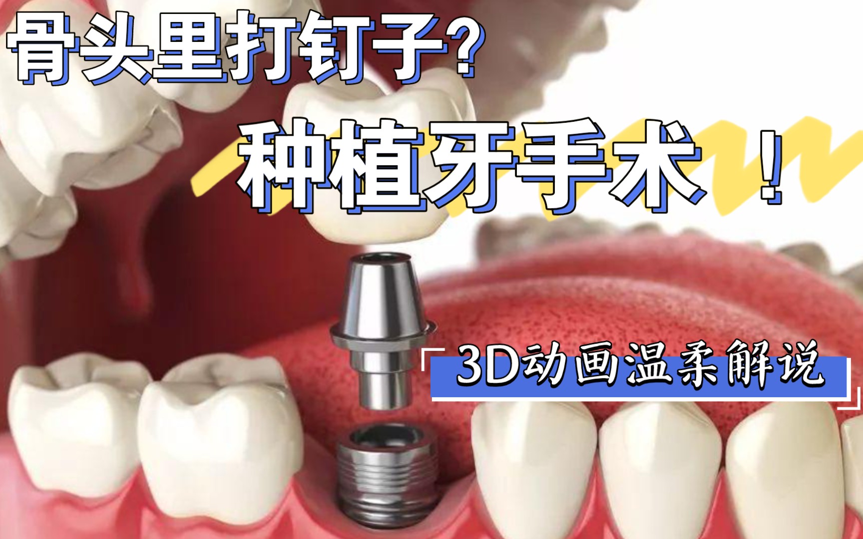 种植牙手术流程详解，种植牙需要多长时间？ - 知乎