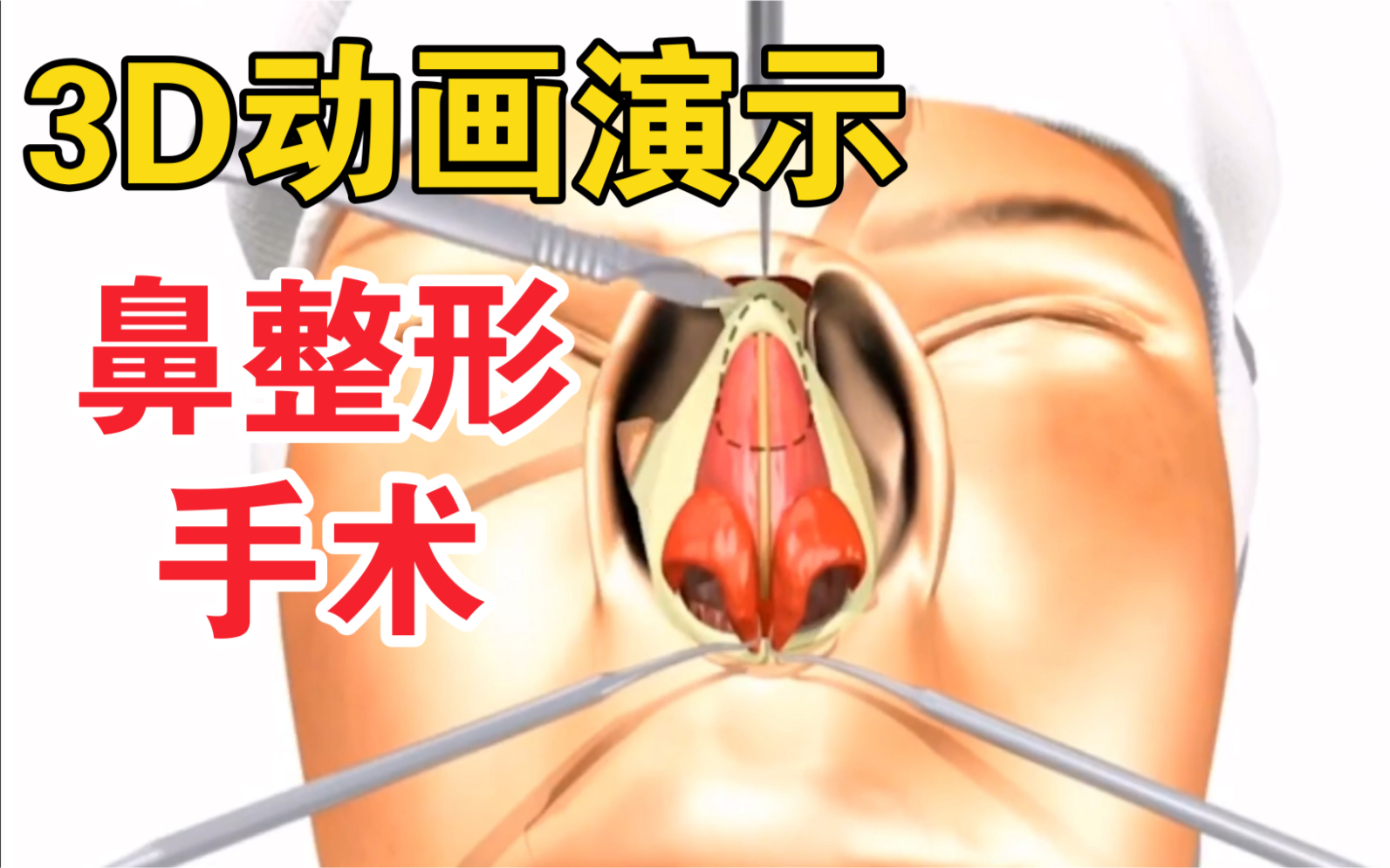 【鼻整形手术】3D动画演示鼻整形手术全过程！