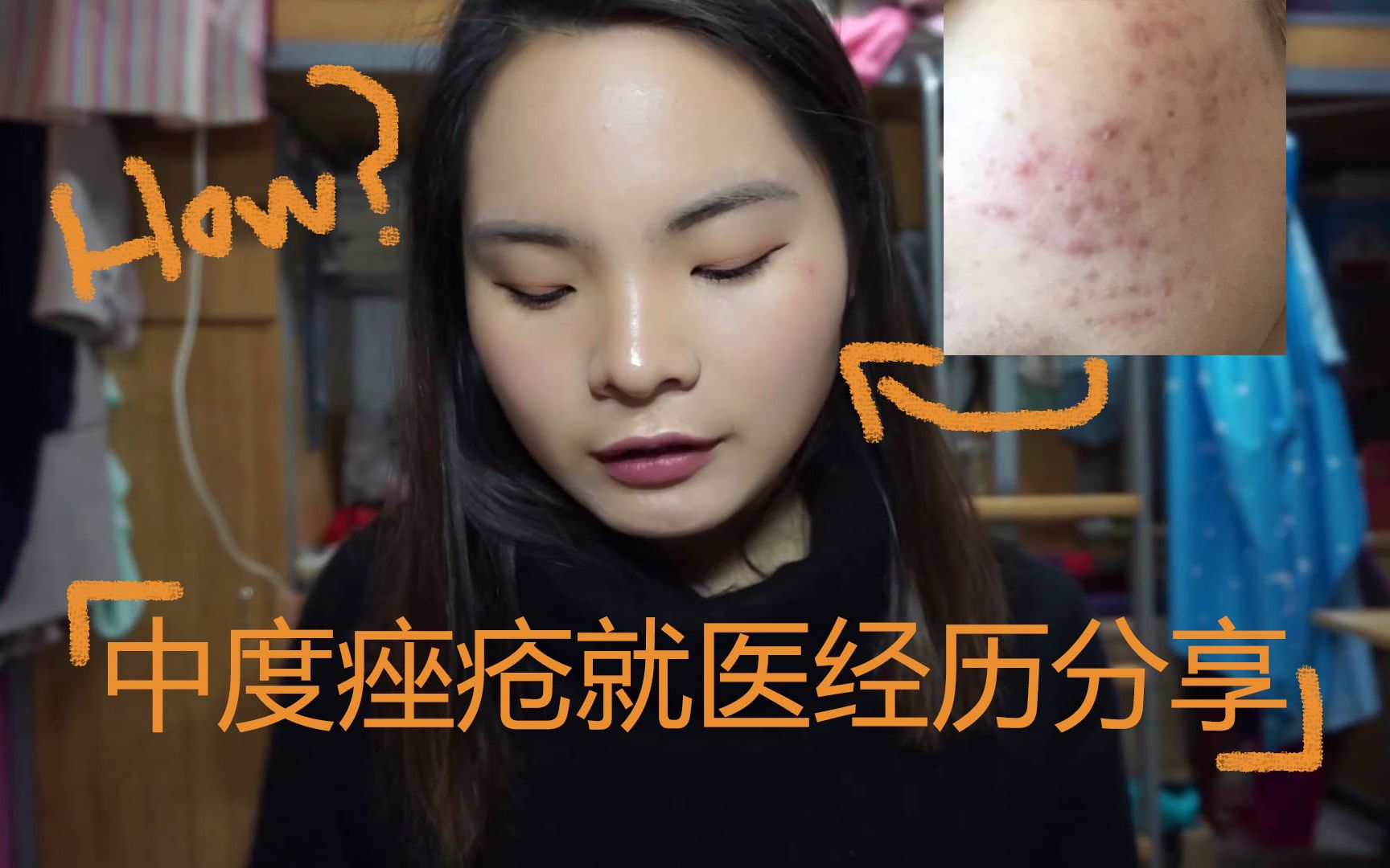 全纪录 / 中度痤疮就医经历分享 / 如何治愈大面积痘痘 / 鲍勃