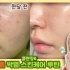 【韩国美妆】无广告!克服成人痘的方法一次全公开·产品推荐♡Asle Makeup