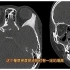 骨纤维异常增殖症典型CT病例分享，简单易懂，实用干货！