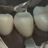 【V类洞制备及修复】Composite Preparation - Restoration Operative Dent