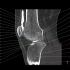 必须收藏！超详细的膝关节CT解剖逐帧播放！