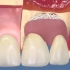 牙龈萎缩牙根外露还能补救吗？龈瓣移植术可以了解一下哦！