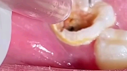 牙洞臭