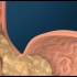 胃食管反流（GERD）| 医学动画 | 双语字幕