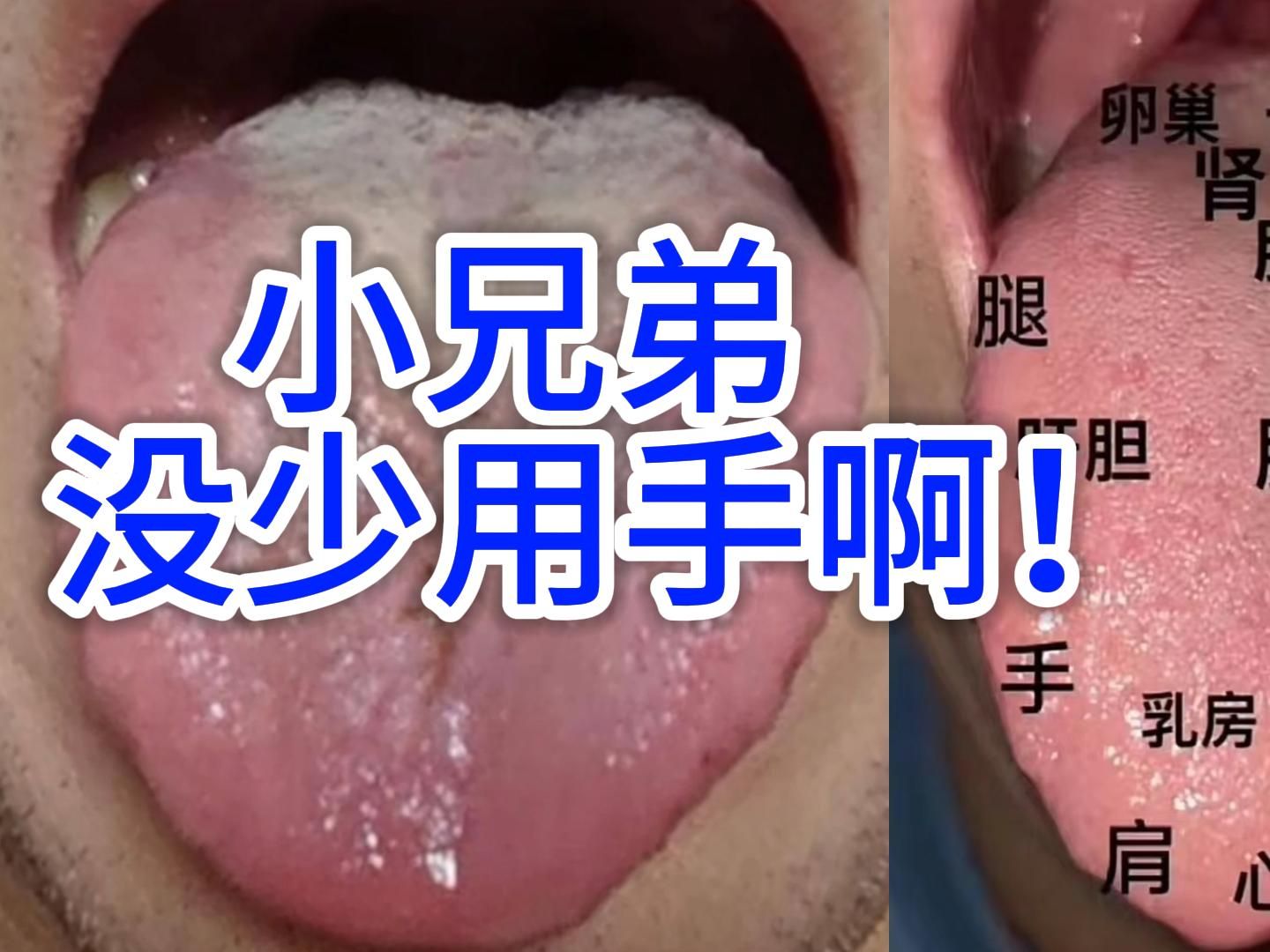 门诊舌象案例分析21：舌根舌苔像豆腐渣，肾太虚了!