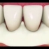 爱牙网：牙周炎治疗过程