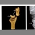 月骨周围脱位——腕骨中段脱位——月骨脱位，腕关节脱位三部曲的影像表现