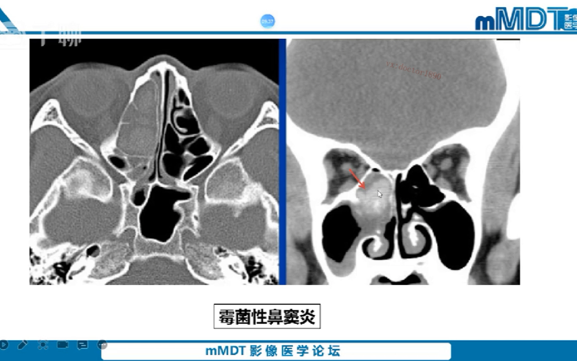 鼻窦鼻腔常见病CT诊断