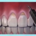 2.出现牙龈萎缩怎么办呢？一起看看吧