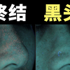 皮肤学博士教护肤：黑头改善教程，消灭黑头怪