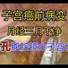 子宫内膜癌前病变（不典型增生），单孔—腹腔镜全子宫切除步骤解析分享，感谢