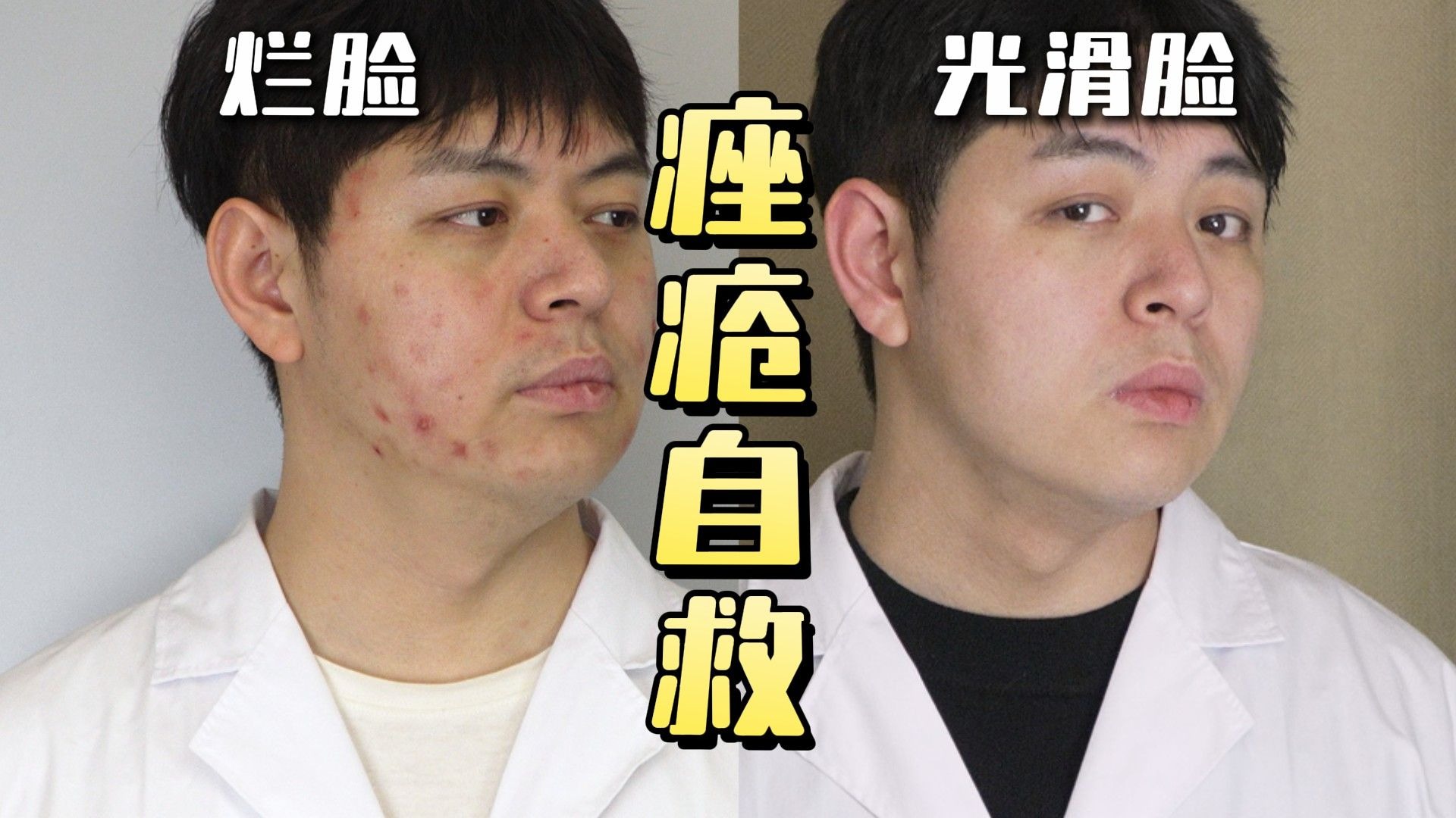 211医学生祛痘实录，到底要花多少钱才能彻底去掉痘痘？