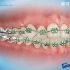 牙齿矫正期间，托槽掉了会产生什么后果？