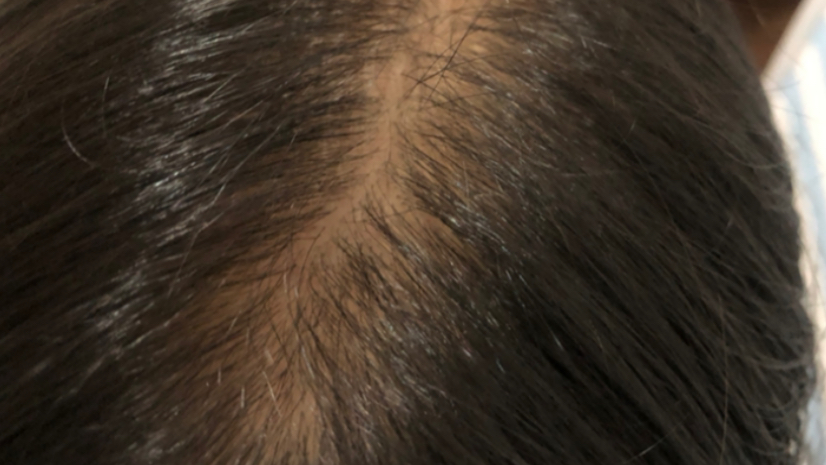 脂溢性脱发5年的秃秃女孩个人经验分享（超时长预警）