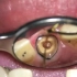 排龈线是放在您牙齿和牙龈之间，有一点点胀胀的感觉，小小排龈线在此处的作用如下。